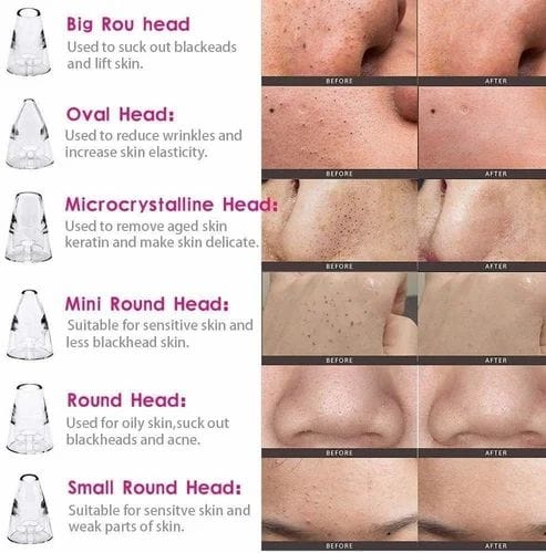 Rechargeable Blackhead Removal Device